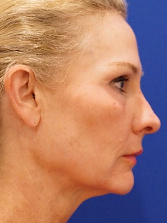 Mini Facelift* — Before