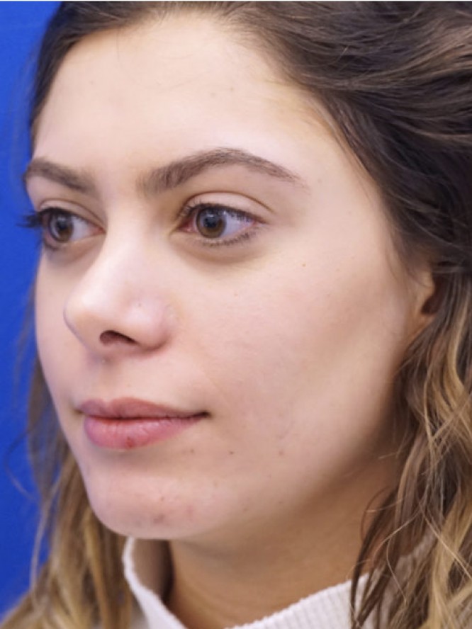 Hump Reduction and Chin Projection — After