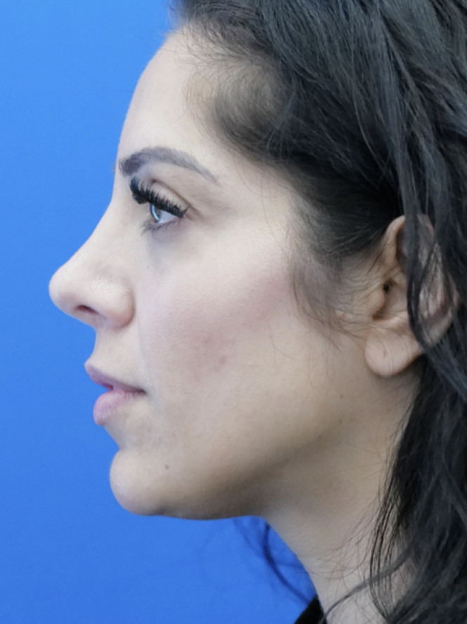 Dorsal Hump and Thick Skin — After