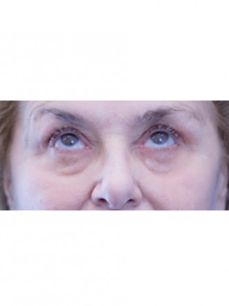 Eyelid Rejuvenation and Fat Transfer to Cheek* — Before