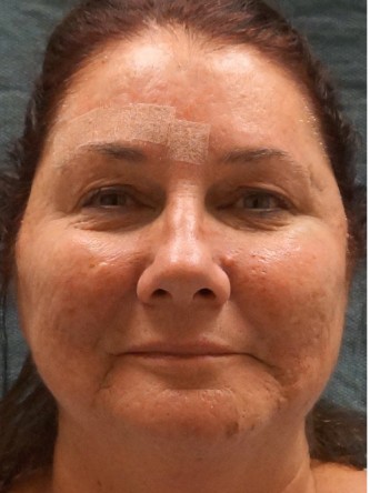 Fractional CO2 Laser Skin Resurfacing3* — Before