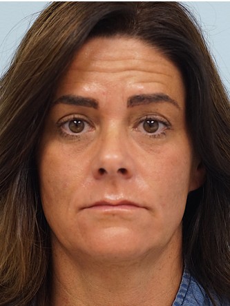 Glabellar Botox and Filler* — Before