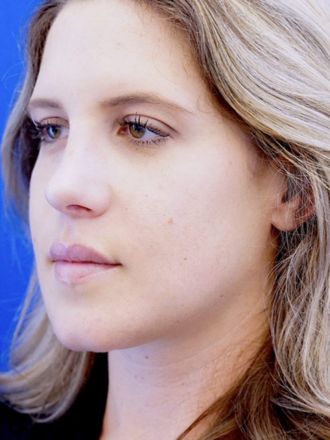 Aesthetic Nasal Profile — After