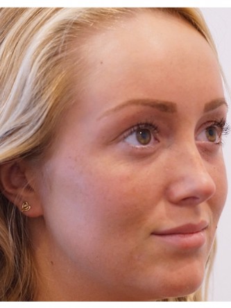 Restylane Silk to Upper & Lower Lips* — Before