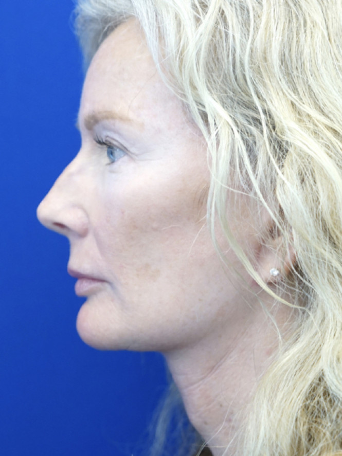Scintillating Natural Result — After