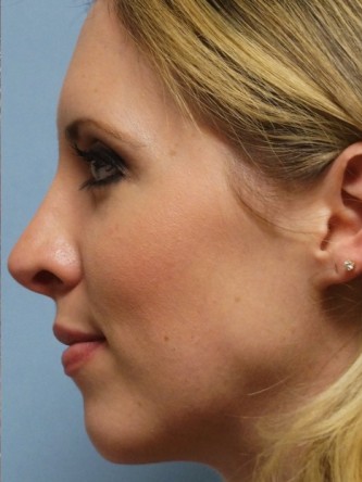 Crooked Nose & Cartilage Deformity1* — After