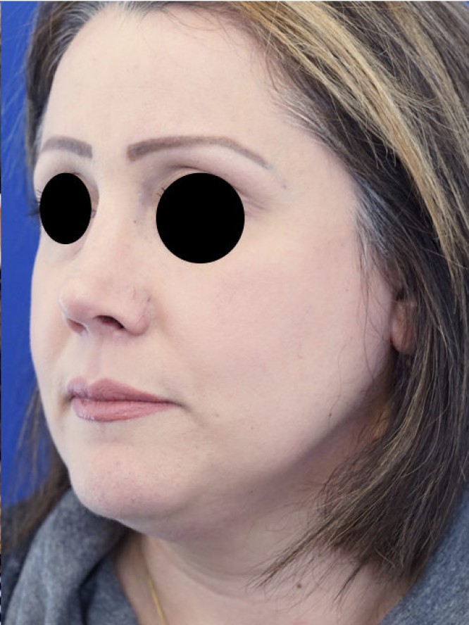 Over-Resected Nose — After