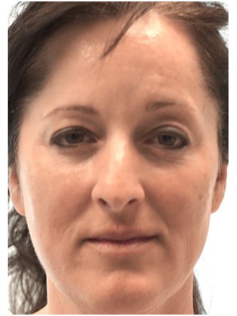 Botox Periorbital – Around the Eyes* — Before