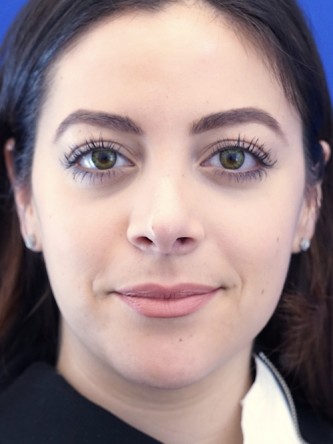 Finesse Nasal Aesthetics* — After