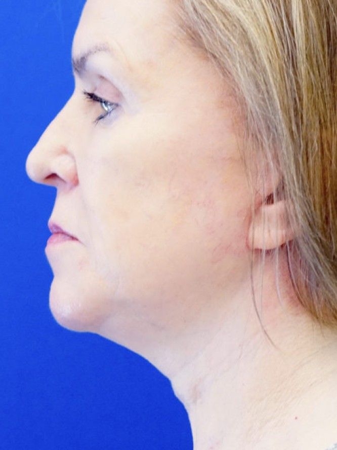 Deep Plane Lift and Fat Grafting — After