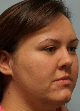 Crooked Nose Endonasal Technique2* — Before