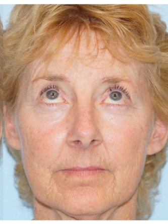 Upper Eyelid Droop2* — After