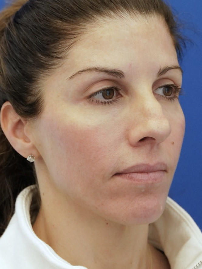 Brow Tip Aesthetic Line — Before