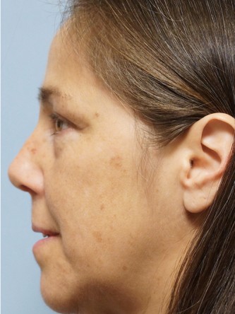 Nasal Septal Perforation2* — After