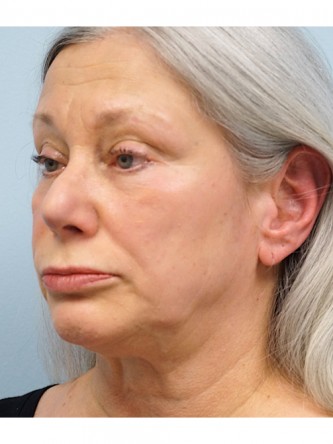 Over Projected Thick Skin Nose* — Before