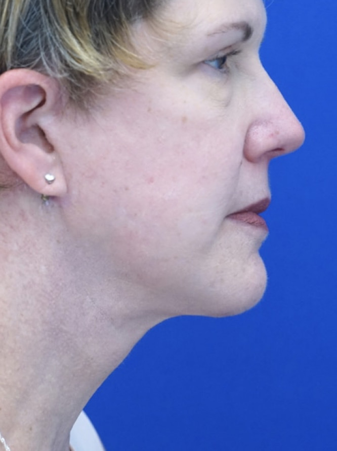 Facelift Platysmaplasty with Subplatysmal Lipectomy — After
