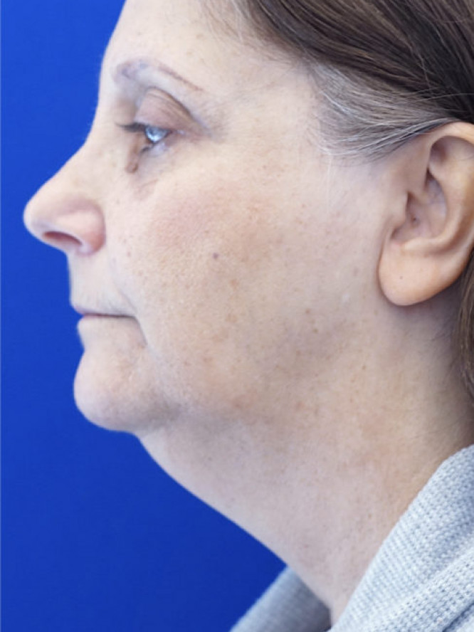 Deep Plane Facelift and Platysmaplasty — Before