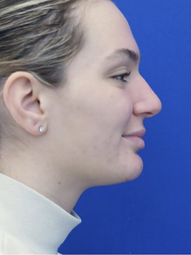 Soft Tissue Chin Reduction — After