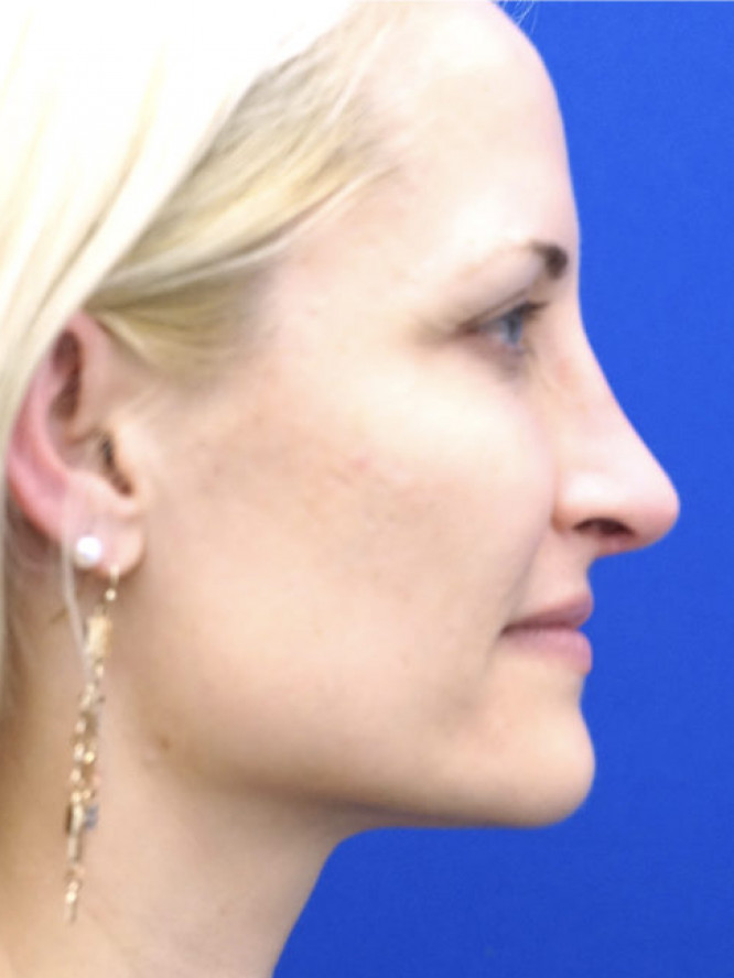 Nasal Profile Finesse — After