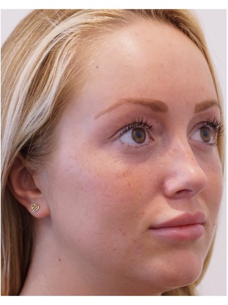 Restylane Silk to Upper & Lower Lips* — After