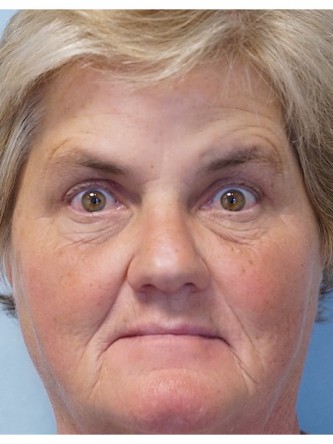 Brow Droop & Upper Eyelid Skin Excess* — After