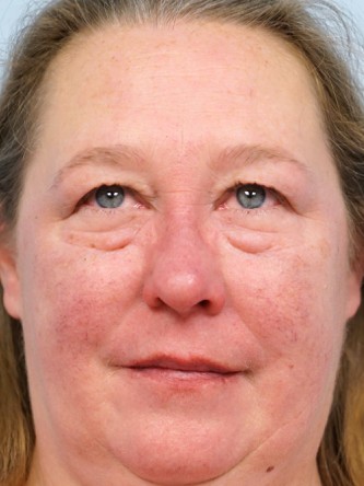 Upper and Lower Eyelid Blepharoplasty* — Before