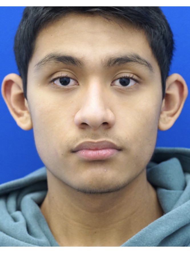 Prominent Ear Reduction — Before