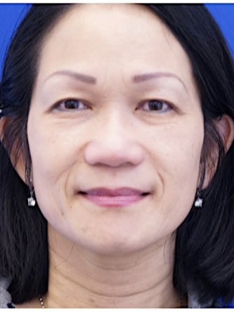 Asian Eyelid Crease Elevation — Before