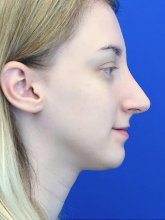 Dorsal Hump and Tension Tip — After