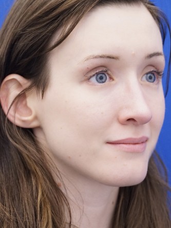 Nasal Profile Irregularity — After