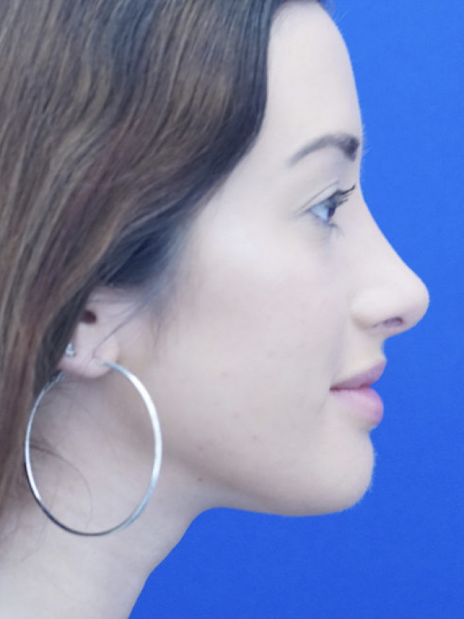 Dorsal Convexity to Concavity — After