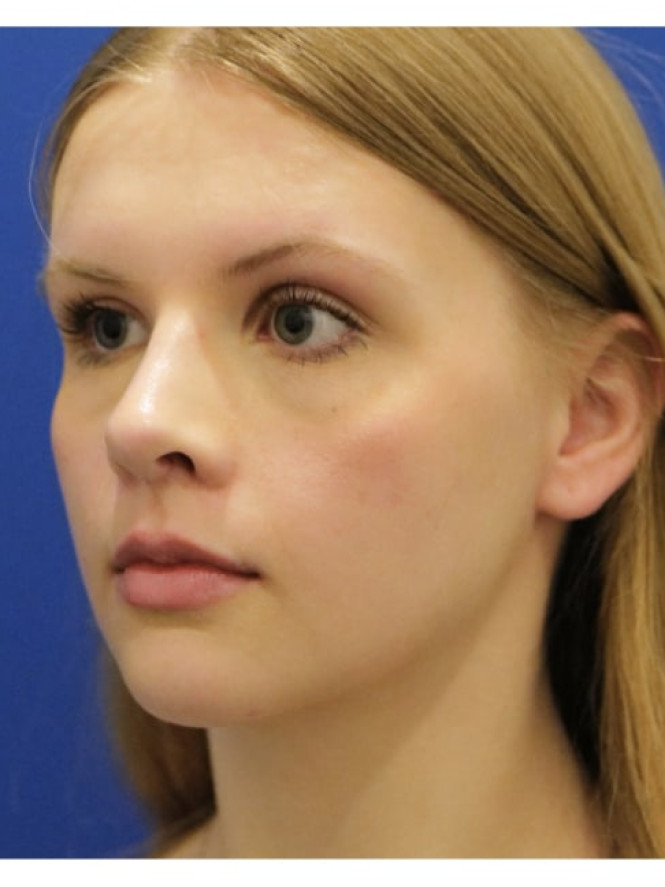 Soften Nasal Appearance — After