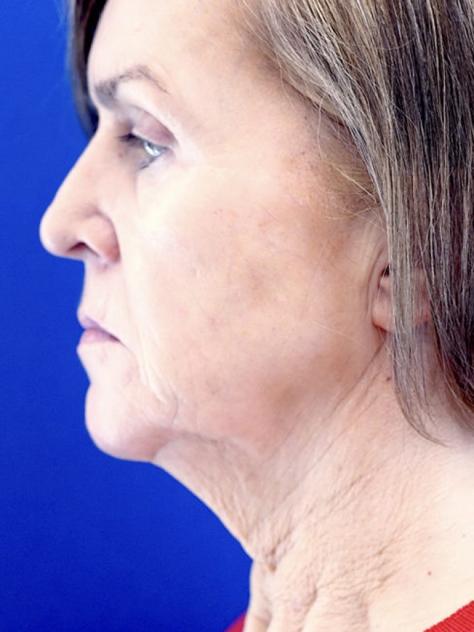 Deep Plane Lift and Fat Grafting — Before