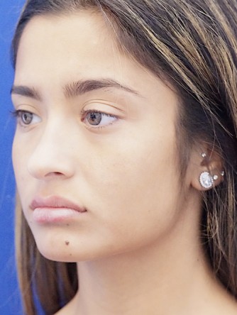 Voluptuous Lip Enhancement* — After