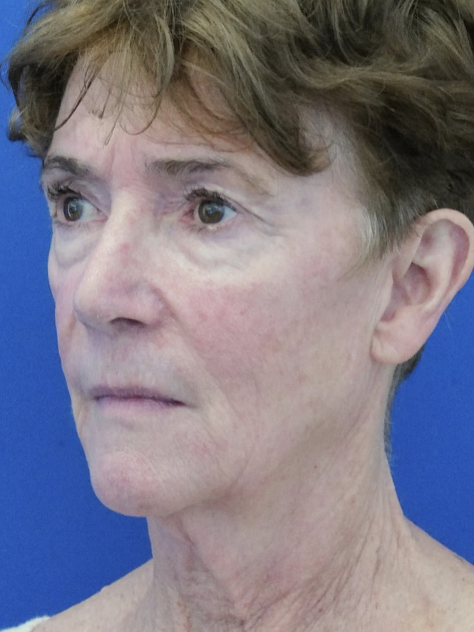 Deep Plane Facelift and Eyelid Lift — Before
