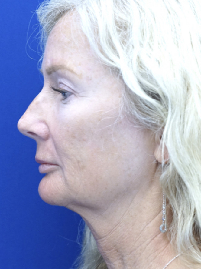 Scintillating Natural Result — Before