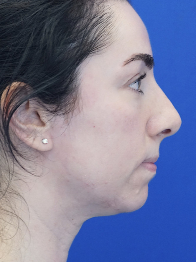 Tip Asymmetry — Before