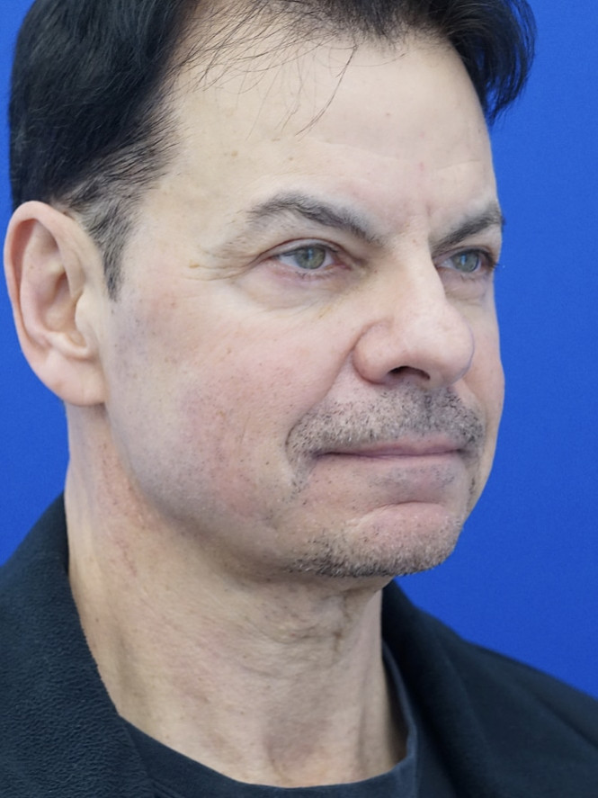 Neck Loose Skin — Before