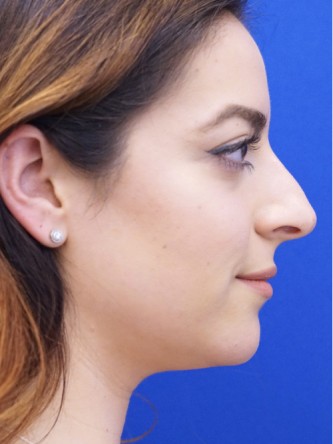 Finesse Nasal Aesthetics* — Before