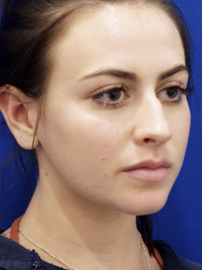 Smooth Dorsal Contour — Before
