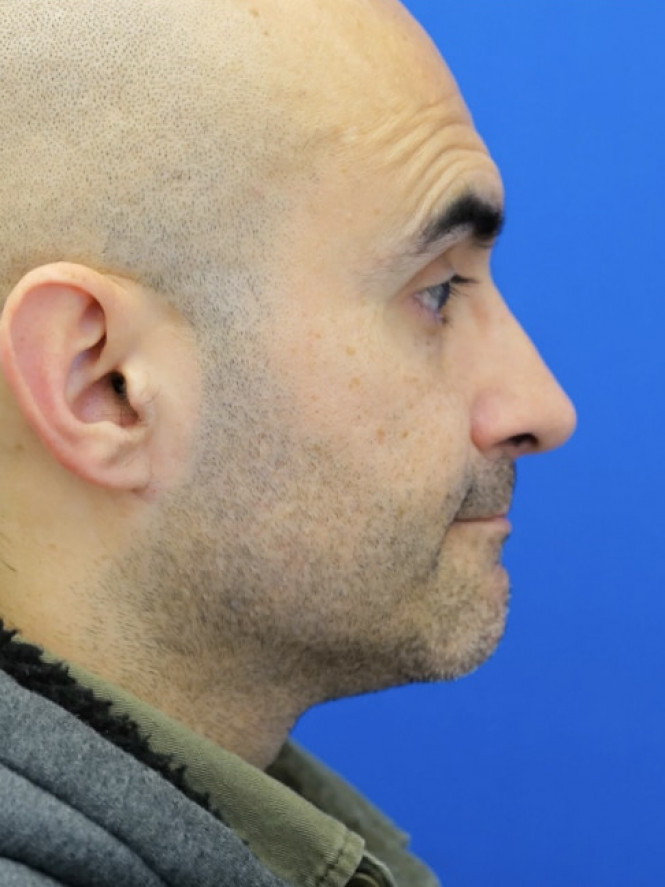 Tension Tip Ptosis — After