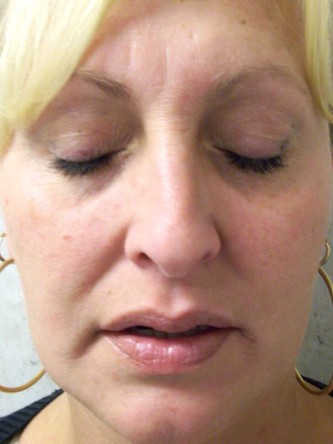 Mild Dorsal Hump & Droopy Tip2* — Before