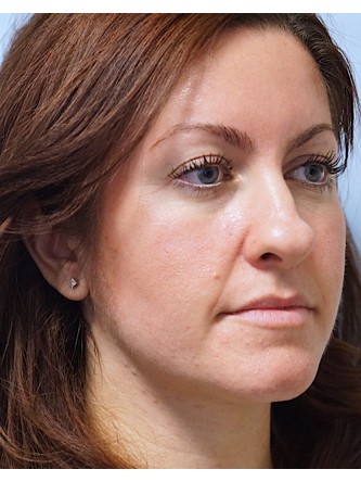 Boxy Tip Endonasal Rhinoplasty* — Before