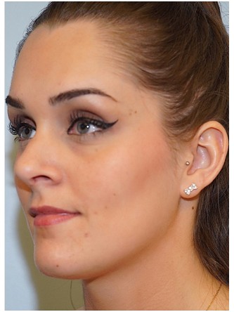 Nasal Septal Perforation1* — After