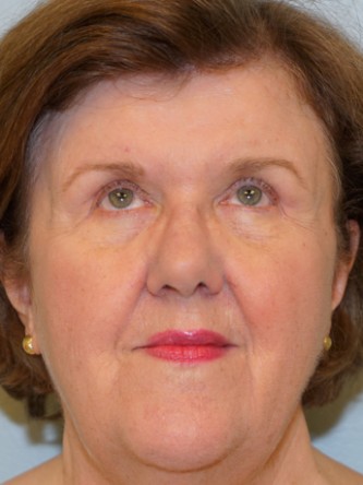Upper Eyelid Skin Excess2* — After