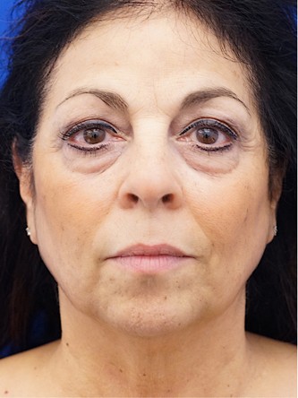 Lower Eyelid Fat Removal* — Before