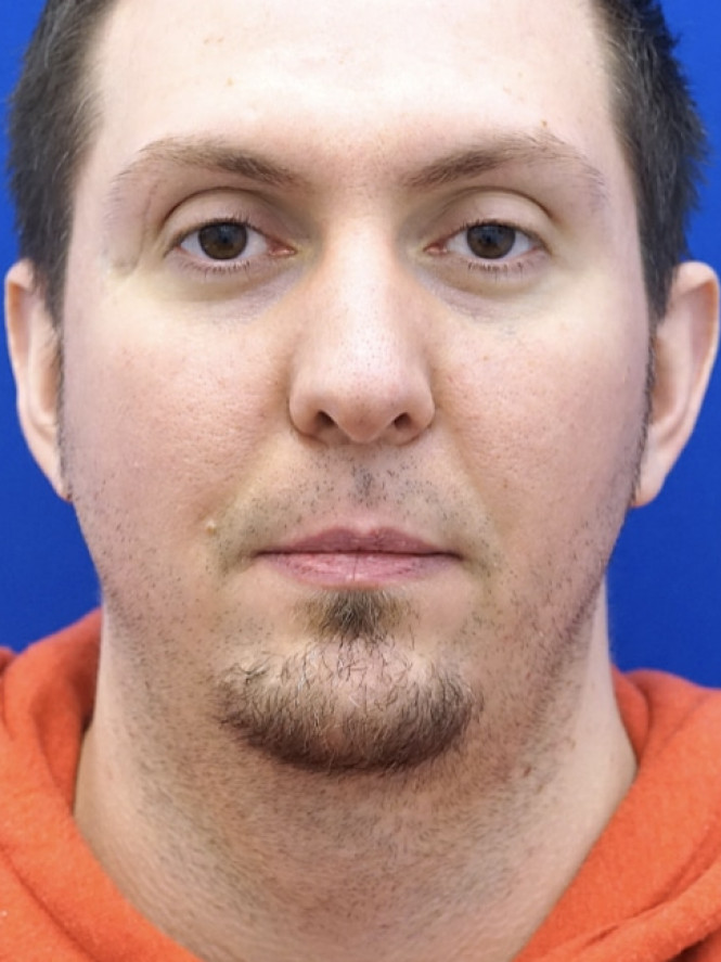 Lower Facial Contouring — Before