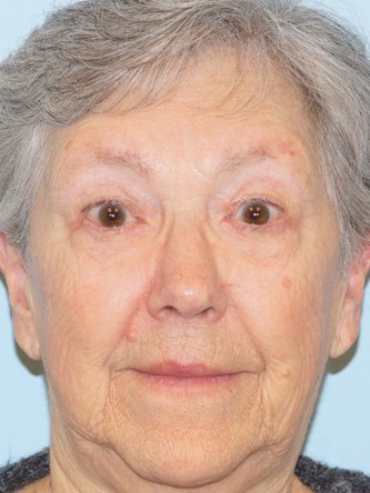Endoscopic Browlift1* — Before