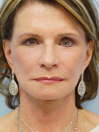 Face/Necklift, Aging Eyelid Surgery, Facial Fat Graft, Laser Resurfacing* — After