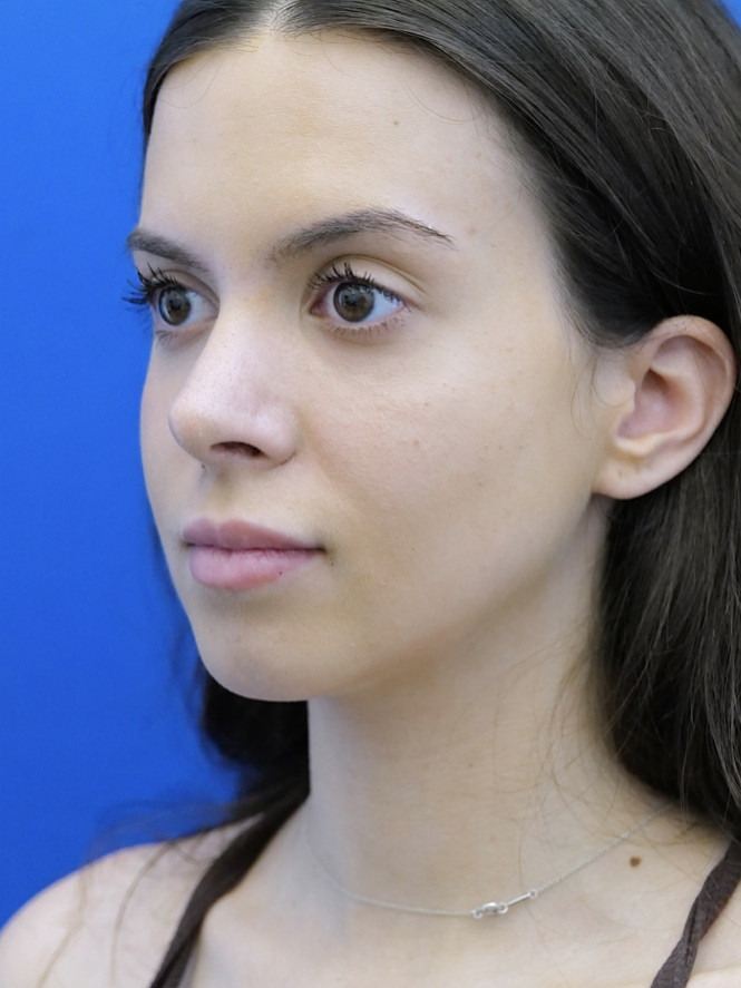 Preservation Rhinoplasty2 — After